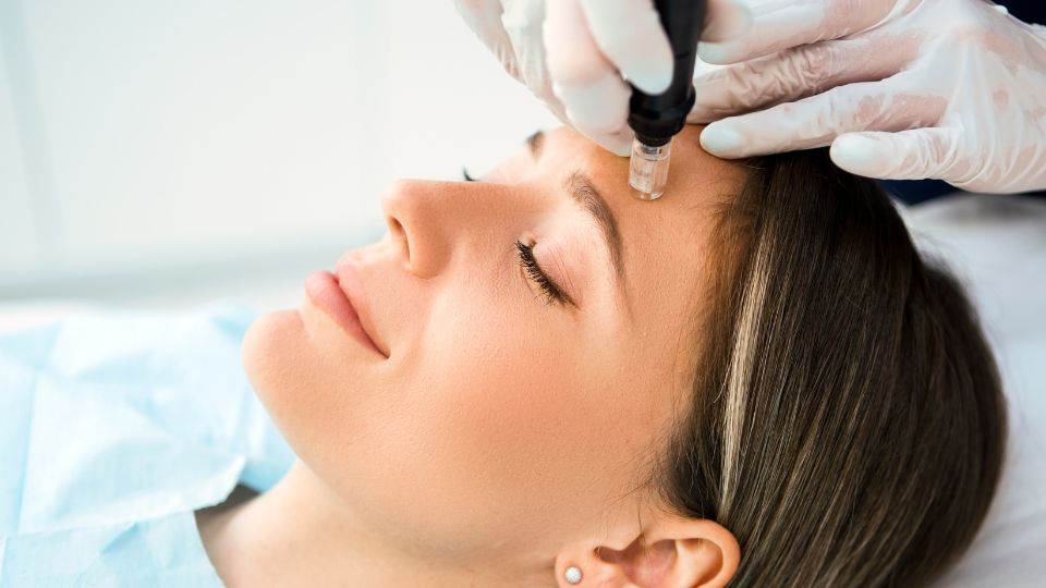 Aplicación de Dermapen o microneedling en clínica estética en Marbella
