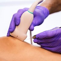 Electrolisis-percutanea-fisioterapia