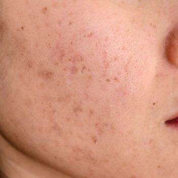 dermapen